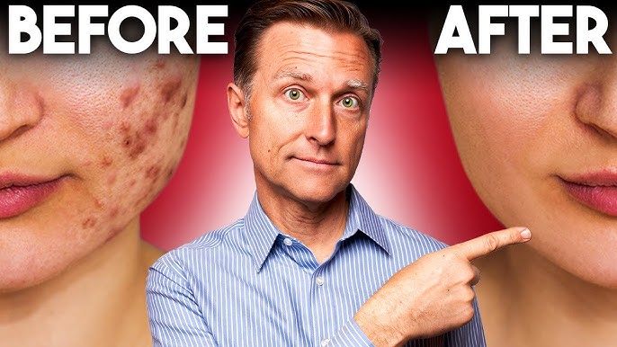 how to Remove acne # como remover acne - Quieres tu rostro limpio? - Cara limpia sin granitos #face clean
