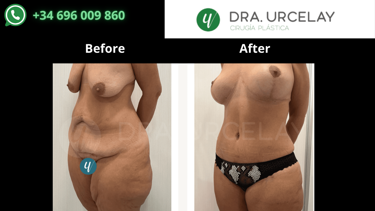 Do you want the body of your dreams? #quieres el cuerpo de tus sueños? #liposuccion-#rinoplastia# Mamoplastia