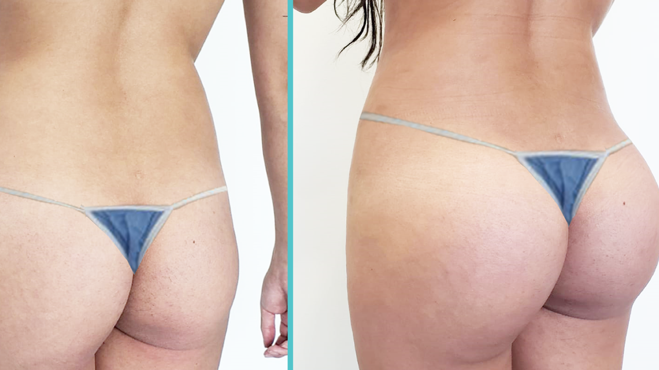 levantamiento de gluteos# - como agrandar mi trasero - como mejorar mis gluteos